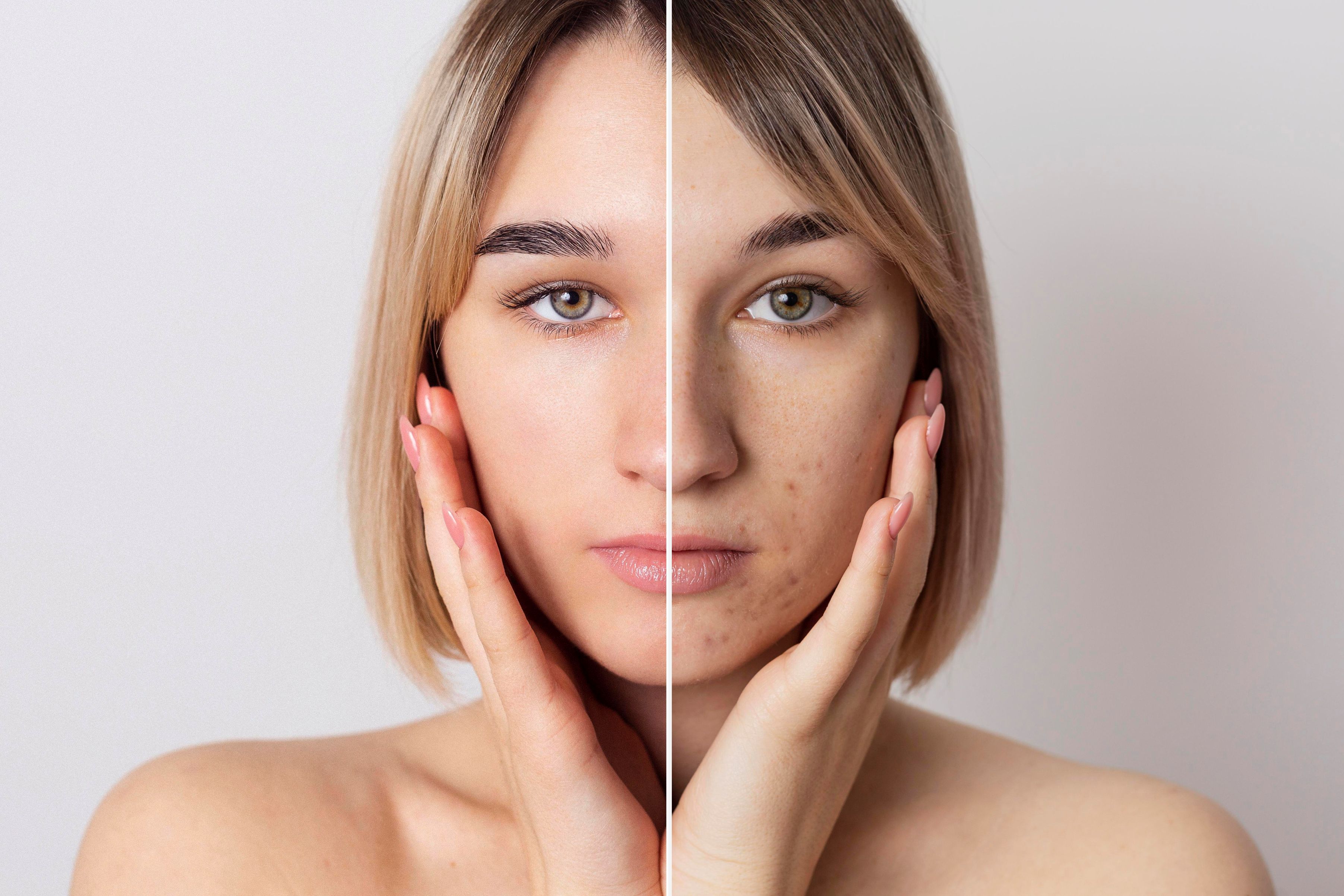 acnee before and after