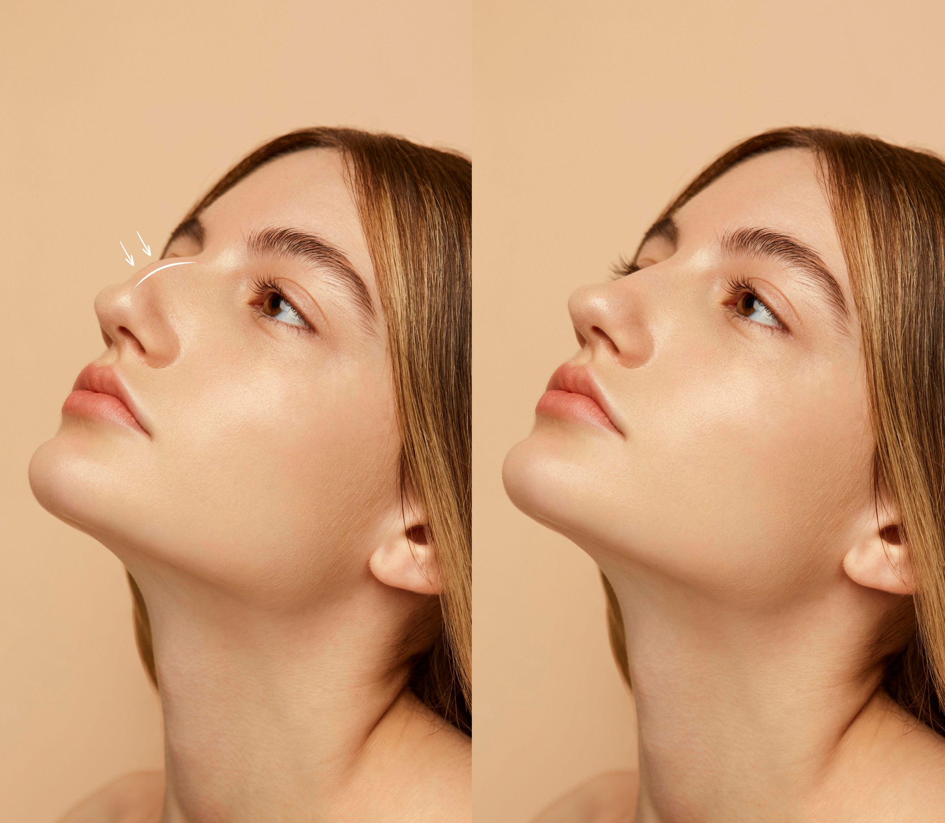 rinoplastie before and after
