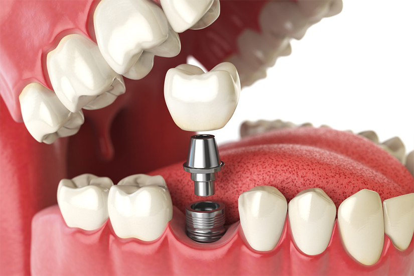 implant dentar